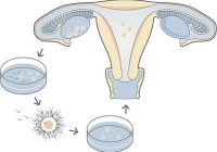 In-vitro_fertilization_(试管婴儿)