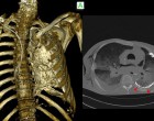 12防腐尸体骨骼系统的计算机断层扫描（CT）成像质量