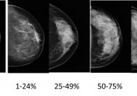乳腺X线摄影与乳腺密度