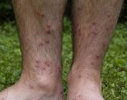230px-cercarial_dermatitis_​​lower_legs
