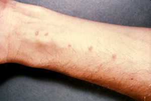 描述：血吸虫尾蚴进入皮肤引起的皮疹照片来源：内容提供商：CDC-commons.wikimedia
