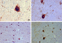 Lewy_bodies_ (alpha_synuclein_inclusions)