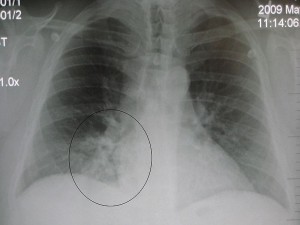 胸部x光片显示右下叶有肺炎。图片来源:詹姆斯·海尔曼，医学博士/维基共享