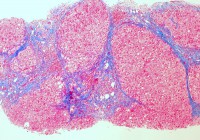 Cirrhosis_of_the_liver_ (trichrome_stain) _ (5690946257)